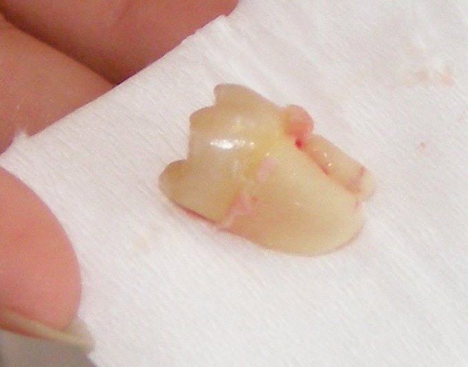 Les conseils post-opératoire après une extraction dentaire