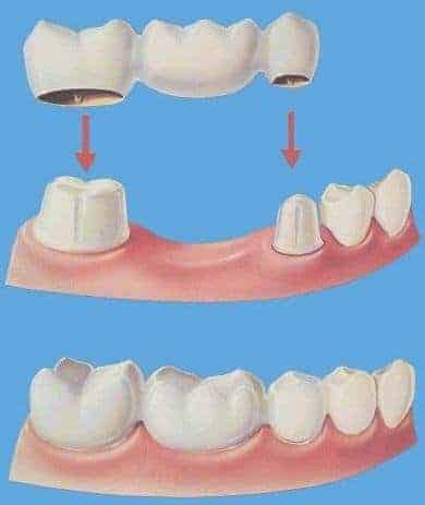 Prothèse dentaire fixe : pont ou bridge
