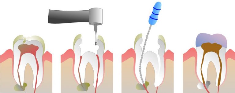 Problèmes de plombage dent – L'obturation dentaire débordée © 